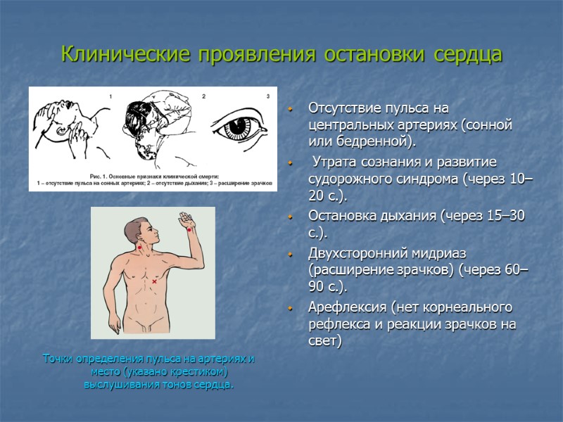 Клинические проявления остановки сердца  Точки определения пульса на артериях и место (указано крестиком)